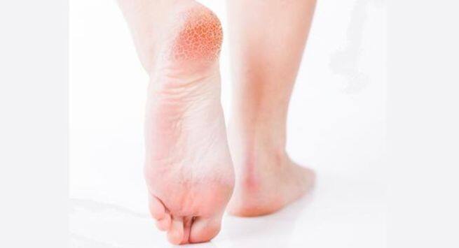 feet skin peeling reasons Hindi