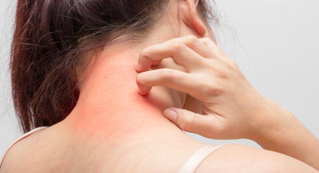 itchiness in hindi