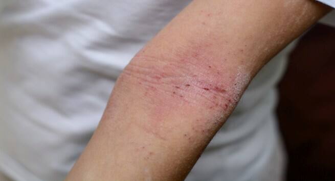 rashes in hindi