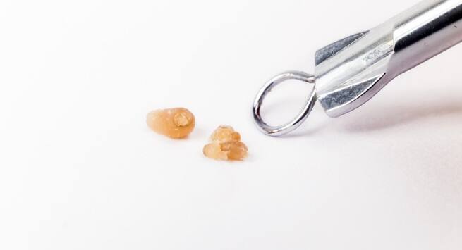 Blackhead-extraction beauty routines you should never DIY at home in indi