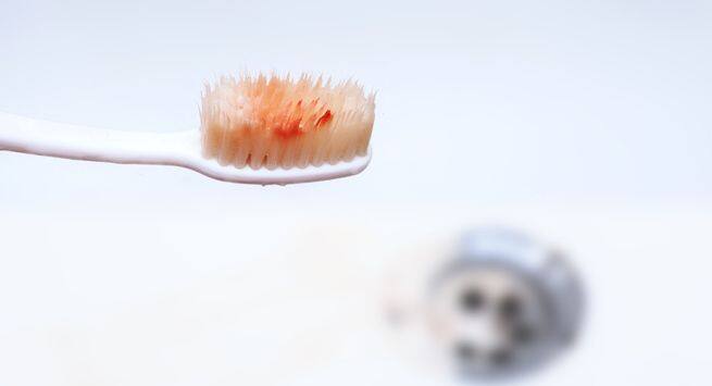 Bleeding-gums