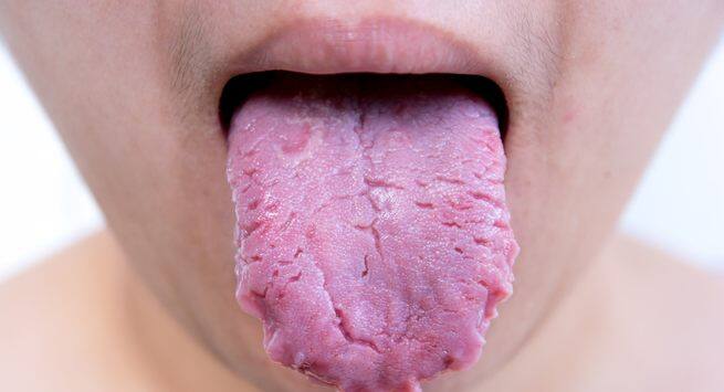 Bumpy tongue