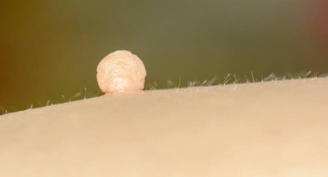Skin tag removal