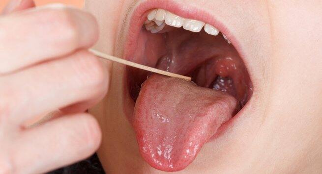 Sores on tongue