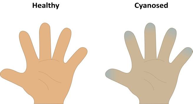 cyanosis common symptoms of pulmonary hypertension