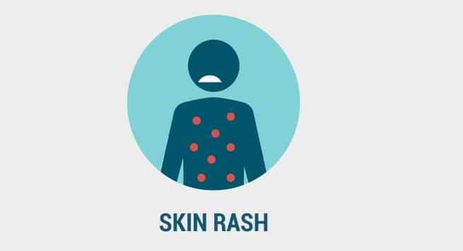 skin-rash-symptoms of zika virus or fever