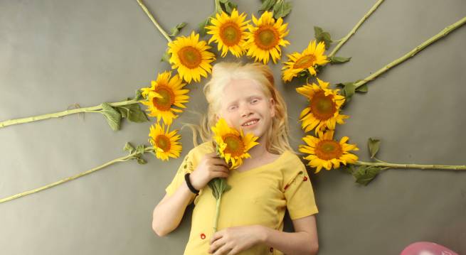 albinism Hindi