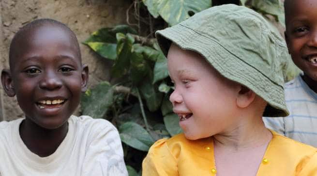 albino-child-in-kenya Hindi