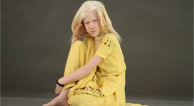 albino-girl Hindi