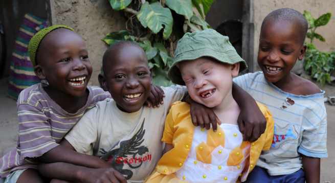albino-kid-with-friends Hindi