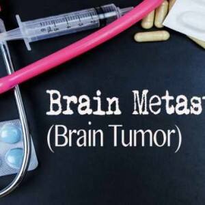 World Brain Tumour Day: Treatment of aggressive brain cancer World Brain Tumour Day: Treatment of aggressive brain cancer