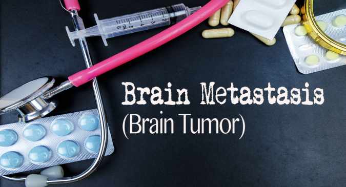 World Brain Tumour Day: Treatment of aggressive brain cancer World Brain Tumour Day: Treatment of aggressive brain cancer