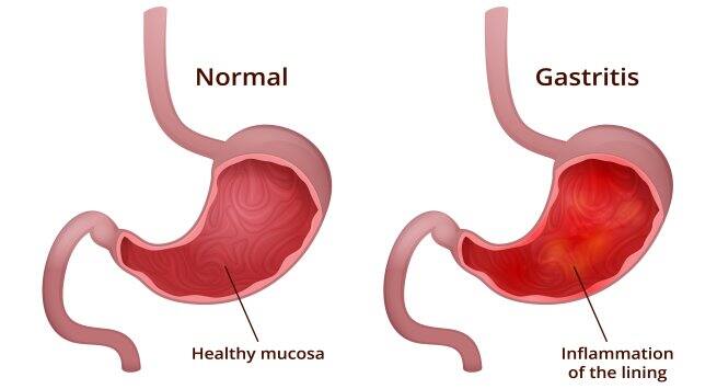 gastritis Hindi