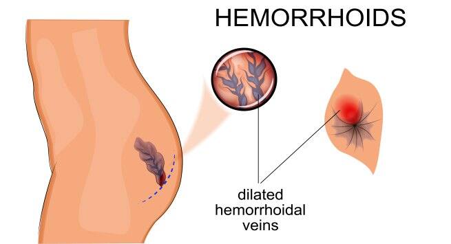 hemorrhoids Hindi