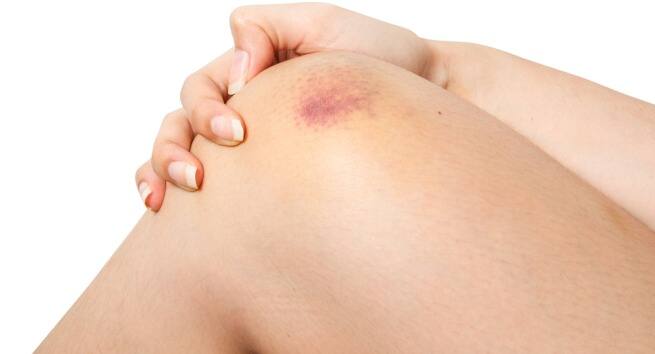 Bruises signs of childhood blood cancer or leukaemia to watch out for