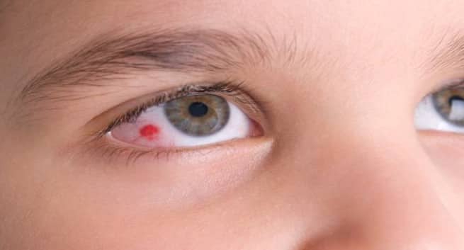 Viral infection of the eyes – symptoms and prevention - Read Health