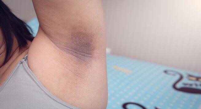 dark underarms