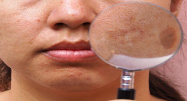 skin darkening