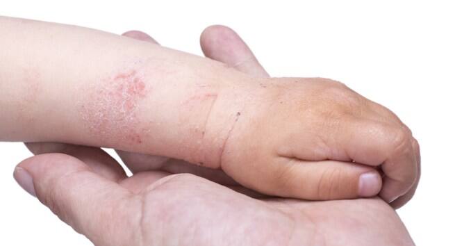 Skin rashes