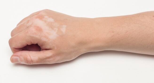 white patches