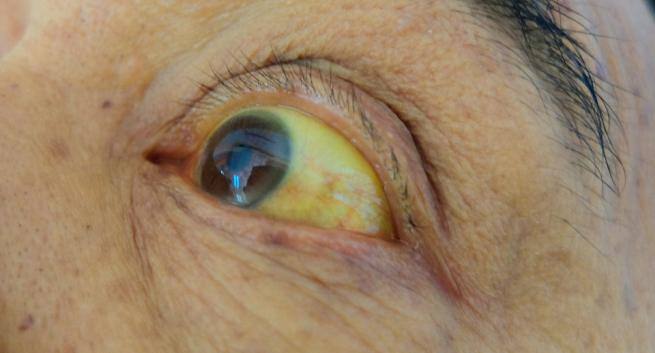 yellow eyes in hindi