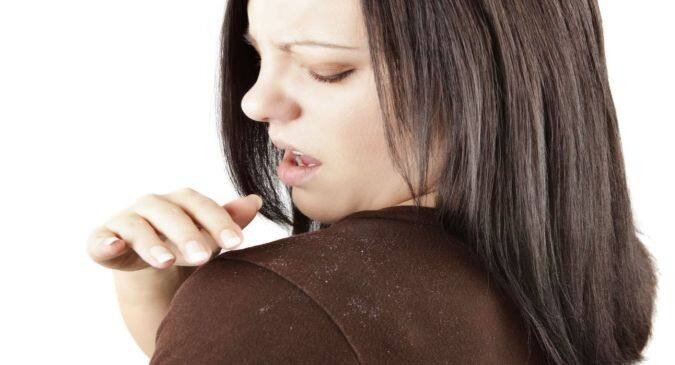 dandruff-aloe vera remedy