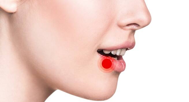 Canker sores
