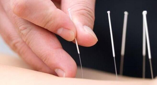 acupuncture
