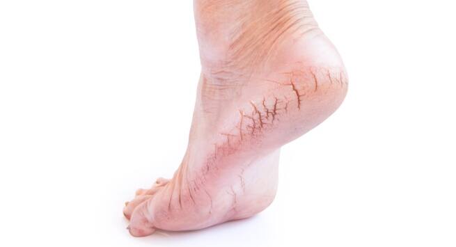 cracked feet