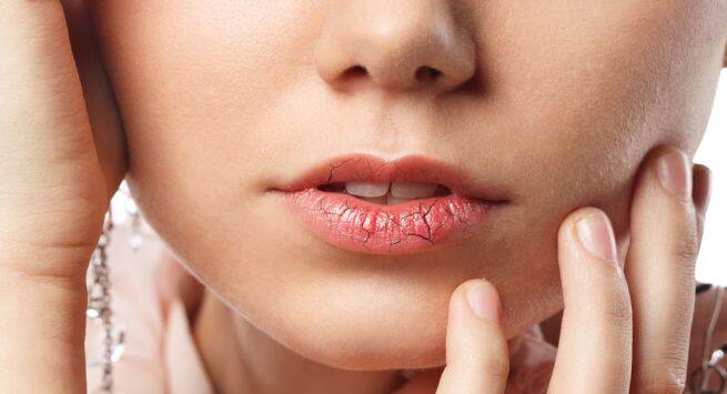 chapped lips