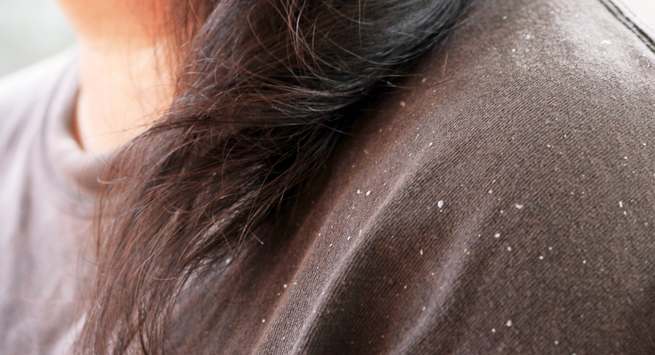dandruff