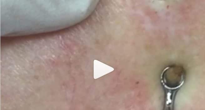 massive pimple pop massive pimple pop