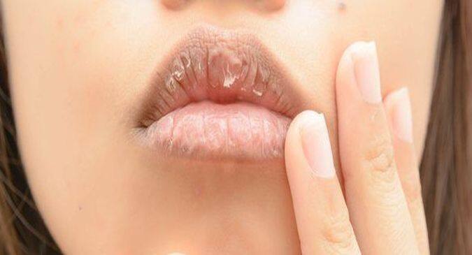 cracked-lips-ad