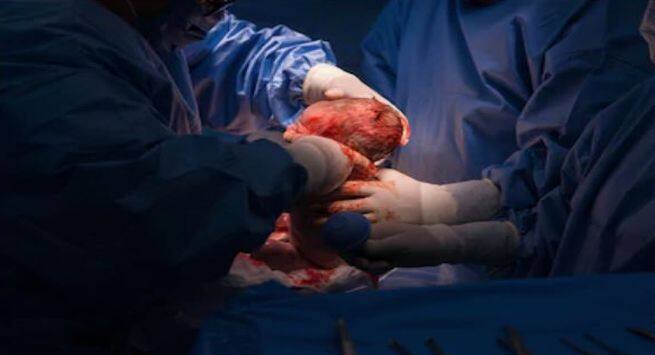 Cesarean9