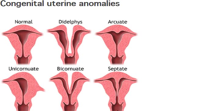 Understanding Congenital Uterine Abnormalities How Does It Impact