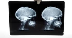 20-day-old baby weighing 1.160 kg undergoes successful brain surgery