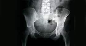 First successful total hip joint replacement surgery in Jammu First successful total hip joint replacement surgery in Jammu