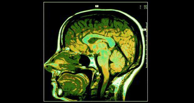 Brain 5