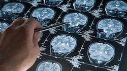 Could a root canal be the reason why this man's memory lasts only for 90 minutes?