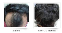 Hair Transplants: Do they work?