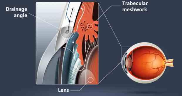 glaucoma