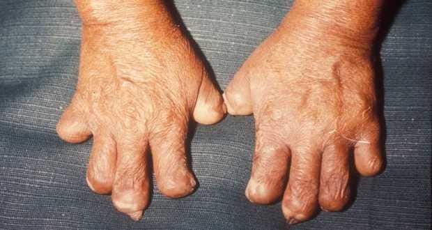 leprosy leprosy