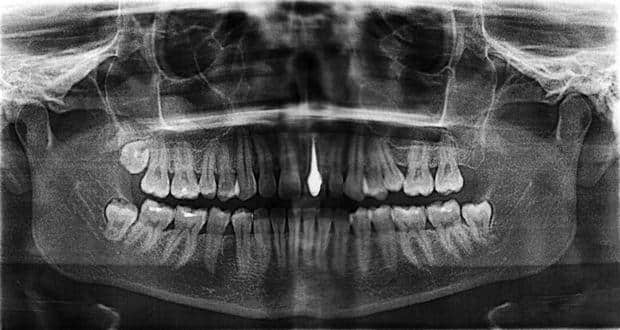 Dental pulp