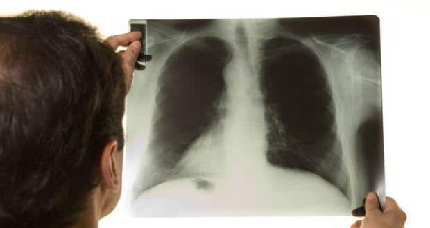 Tuberculosis