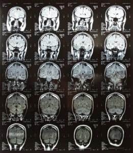 mri scan