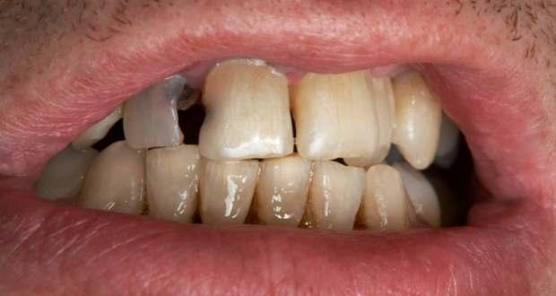 poor oral hygeine