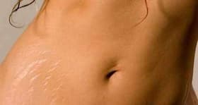 Lighten stretch marks with 6 DIY home remedies Lighten stretch marks with 6 DIY home remedies