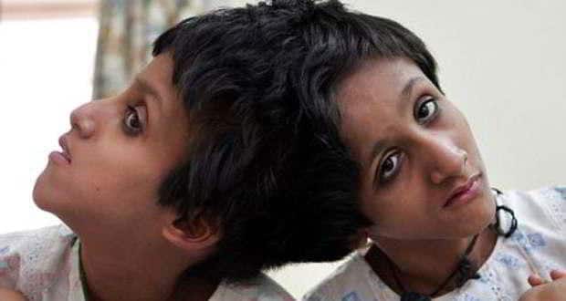 bihar's conjoined twins
