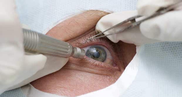 cataract