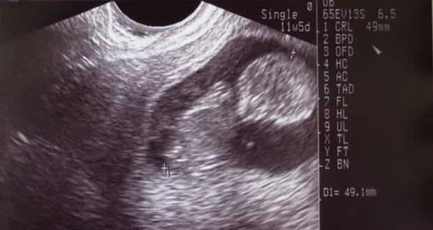 Ultrasound-sonography